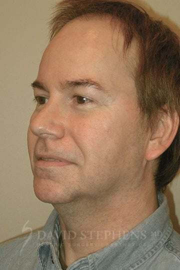 Male Facelift and Neck Lift - Actual Patient Results - Before - 2