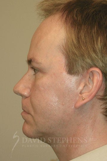 Male Facelift and Neck Lift - Actual Patient Results - After - 3