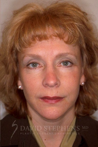 Facelift-Patient-01 | After Facelift