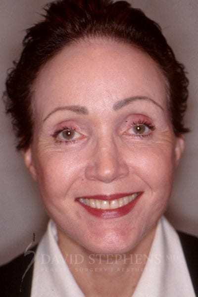 Facelift-Patient-02 | After Facelift