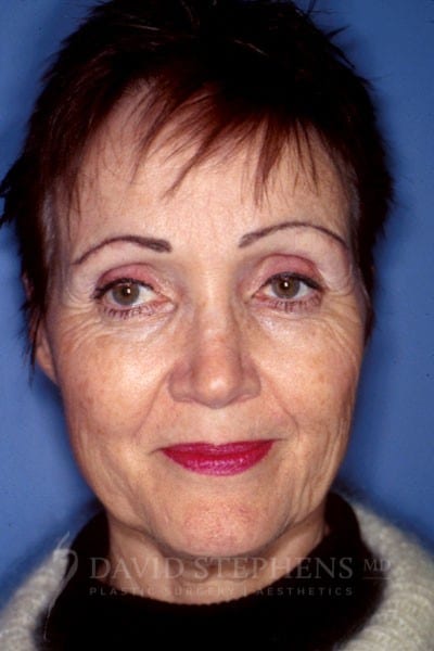 Facelift-Patient-02 | Before Facelift