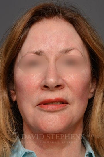 Facelift-Patient-05 | After Facelift