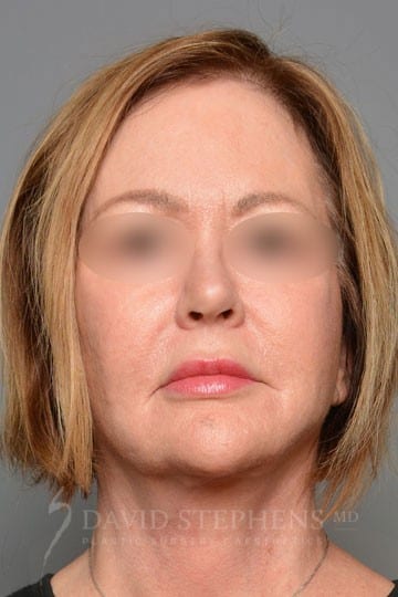 Facelift-Patient-06 | After Facelift