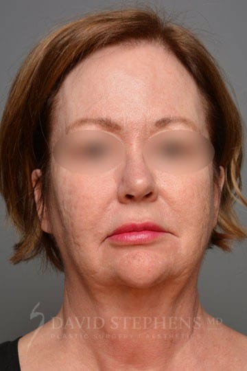 Facelift-Patient-06 | Before Facelift