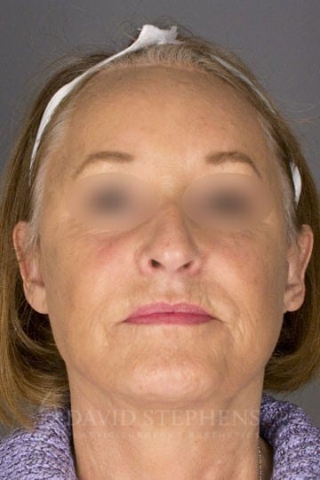 Facelift-Patient-07 | After Facelift