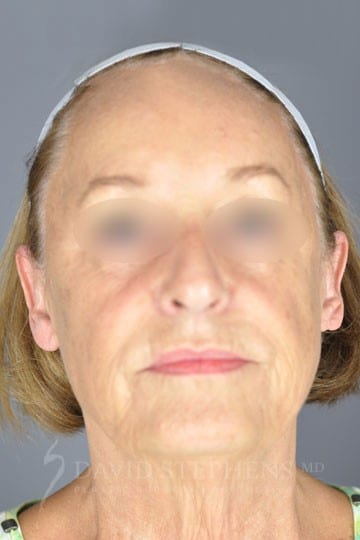 Facelift-Patient-07 | Before Facelift