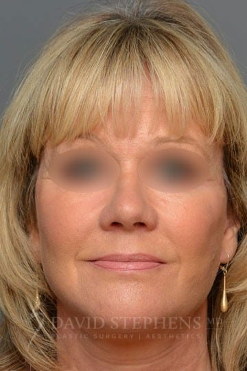 Facelift-Patient-08 | After Facelift