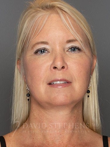 Facelift-Patient-10 | After Facelift