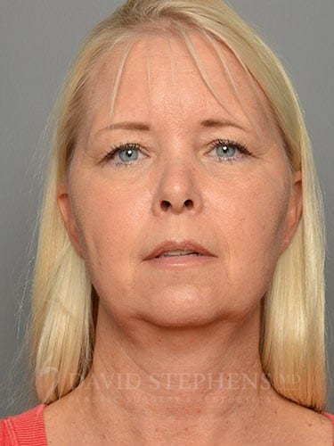 Facelift-Patient-10 | Before Facelift