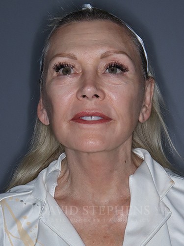 Facelift-Patient-14 | After Facelift