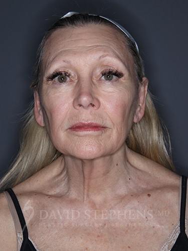 Facelift-Patient-14 | Before Facelift