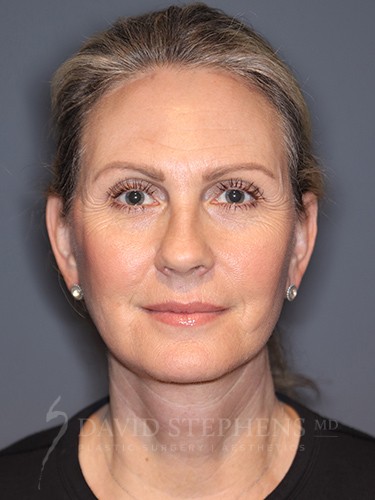 Facelift-Patient-15 | After Facelift