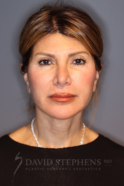 Facial Rejuvenation - Actual Patient Results - After - 2