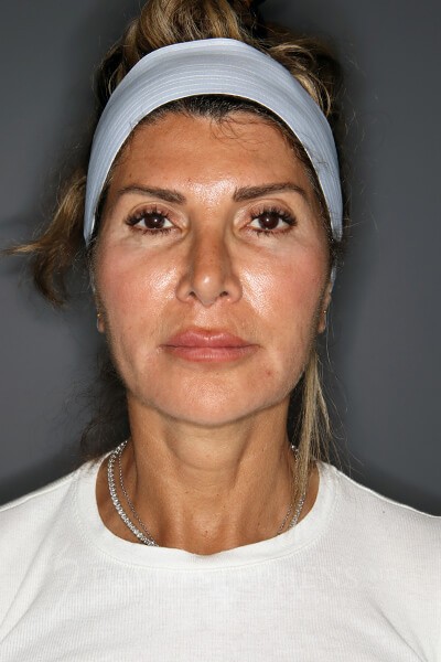 Facial Rejuvenation - Actual Patient Results - Before - 2