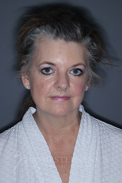Facelift-Patient-17 | Before Facelift