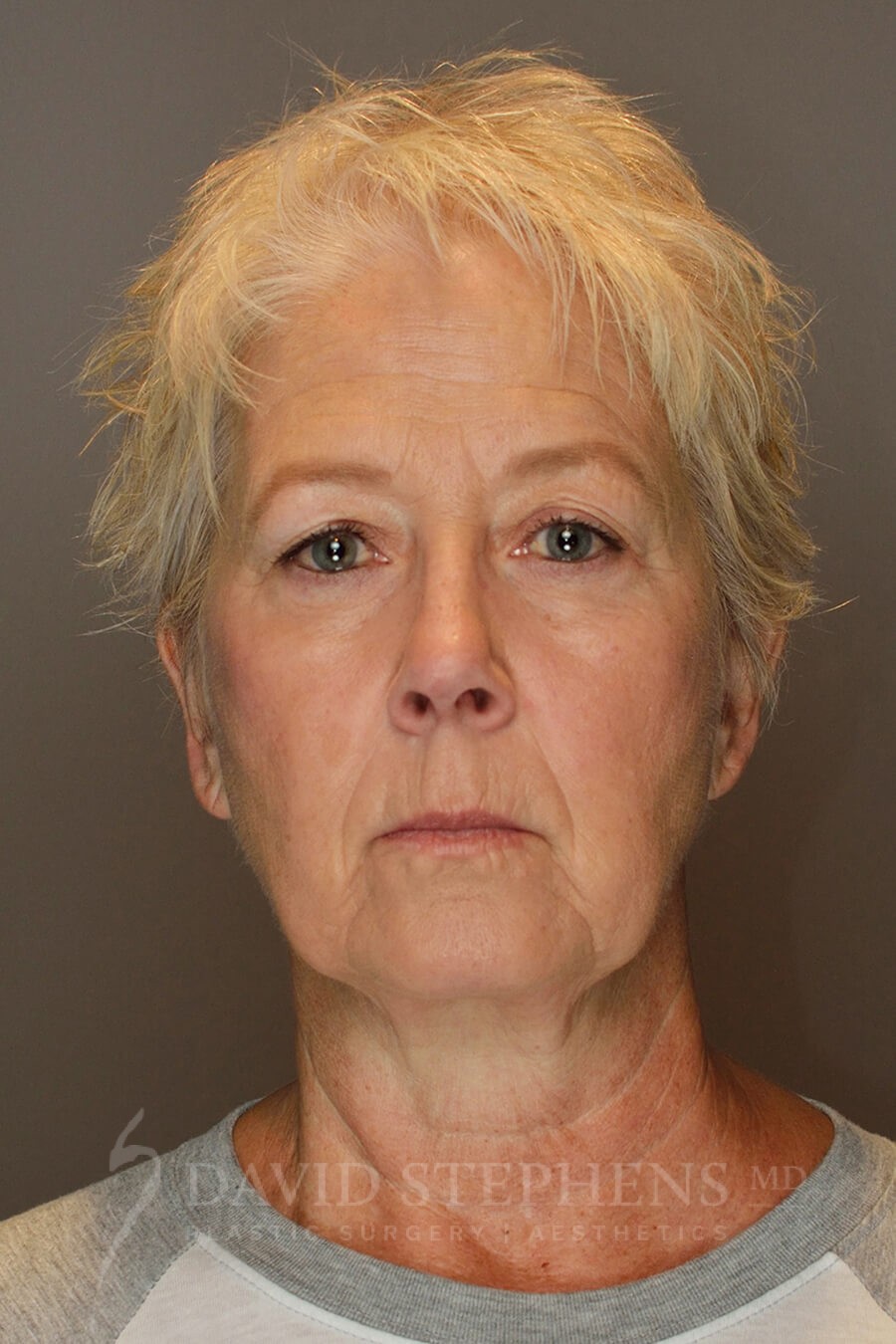 Deep-Plane Facelift - Actual Patient Results - Before - 1