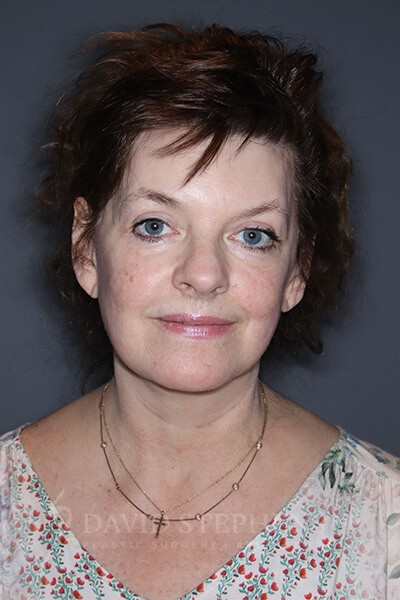 Facelift-Patient-17 | After Surgical