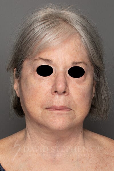 Facelift-Patient-11 | After Facelift