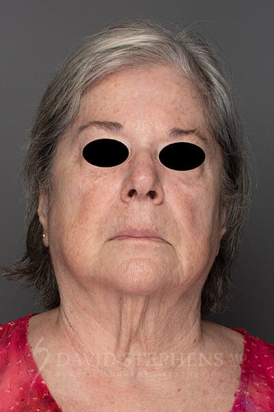 Facelift-Patient-11 | Before Facelift