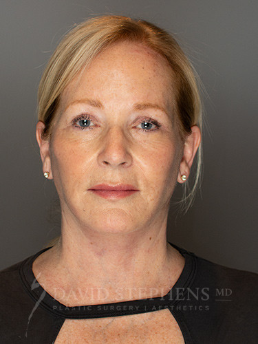 Facelift-Patient-13 | After Facelift