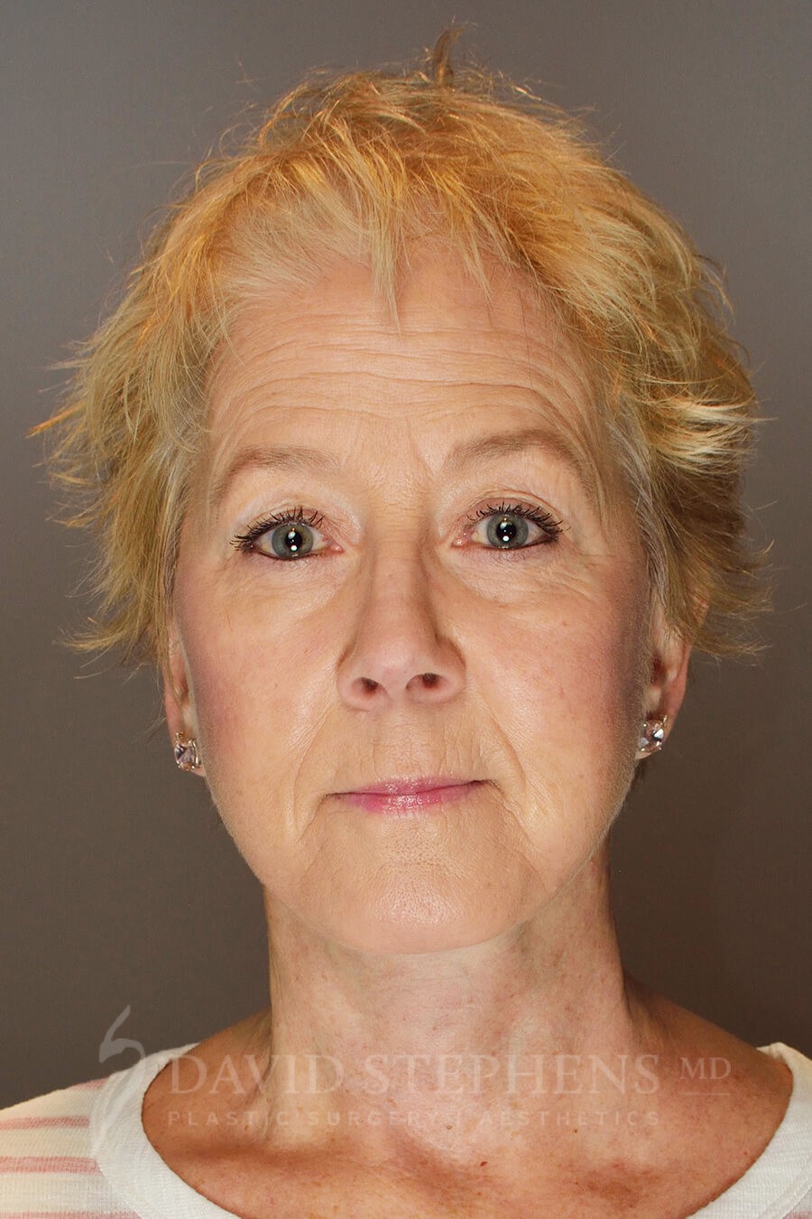 Facelift-Patient-18 | After Surgical