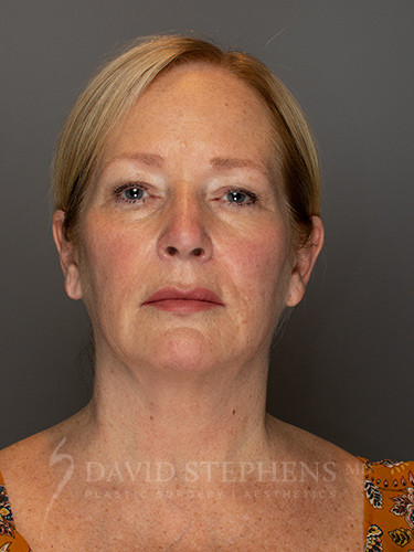 Facelift-Patient-13 | Before Facelift