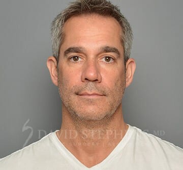 Facetite before image.