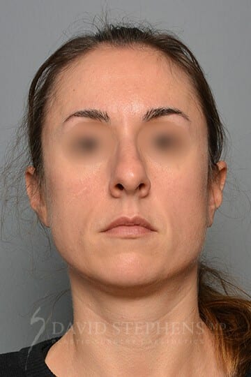 Rhinoplasty before image.