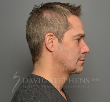 Facetite-Patient-01 | After FaceTite®