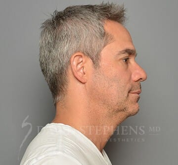 Facetite-Patient-01 | Before FaceTite®