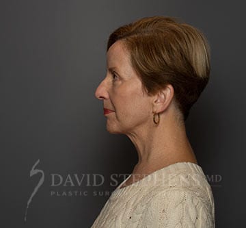 Facetite-Patient-02 | After FaceTite®