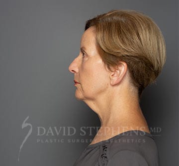 Facetite-Patient-02 | Before FaceTite®