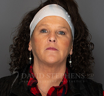 Facetite-Patient-03 | After FaceTite®