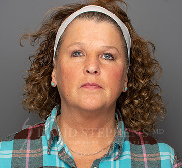 Facetite-Patient-03 | Before FaceTite®