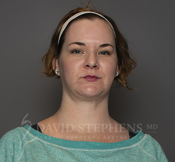 Facetite-Patient-04 | After FaceTite®