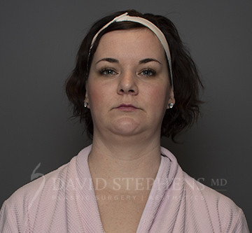 Facetite-Patient-04 | Before FaceTite®