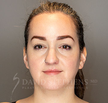 Facetite-Patient-05 | After FaceTite®