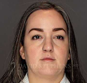 Facetite-Patient-05 | Before FaceTite®