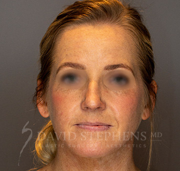 Facetite-Patient-06 | After FaceTite®