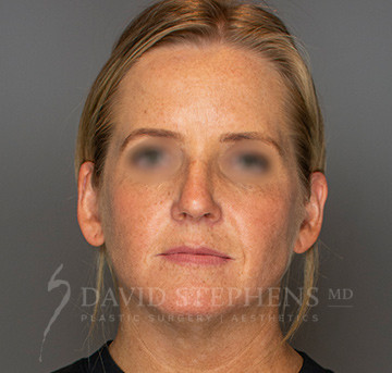 Facetite-Patient-06 | Before FaceTite®