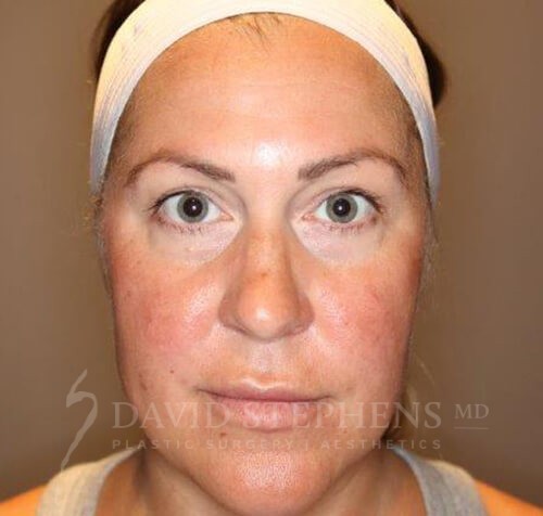 Facetite-Patient-07 | Before FaceTite®