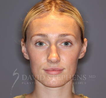 Facetite-Patient-08 | After FaceTite®