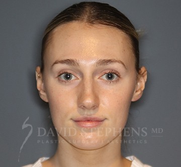 Facetite-Patient-08 | Before FaceTite®