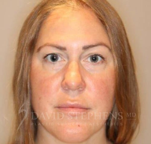 FaceTite-Patient-07 | After Facetite