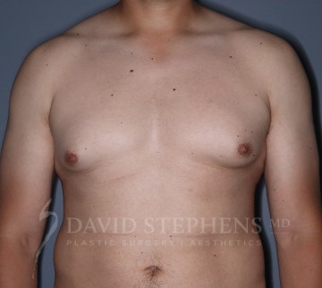 Gynecomastia-Patient-07 | Before Gynecomastia