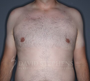 Gynecomastia-Patient-08 | After Gynecomastia