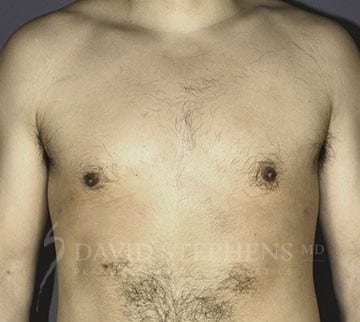 Gynecomastia-Patient-01 | After Gynecomastia