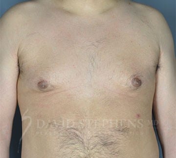 Gynecomastia-Patient-01 | Before Gynecomastia