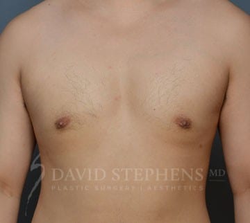 Cosmetic Surgery for Men - Actual Patient Results - After - 1