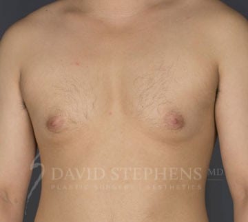 Cosmetic Surgery for Men - Actual Patient Results - Before - 1